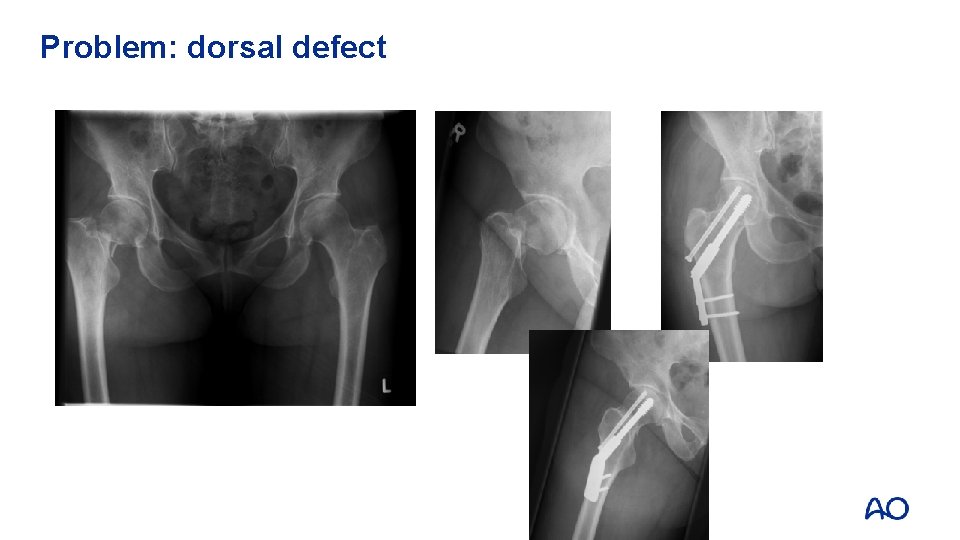 Problem: dorsal defect 