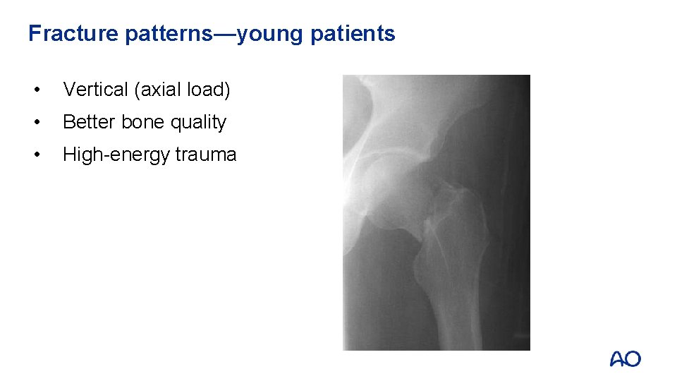 Fracture patterns—young patients • Vertical (axial load) • Better bone quality • High-energy trauma