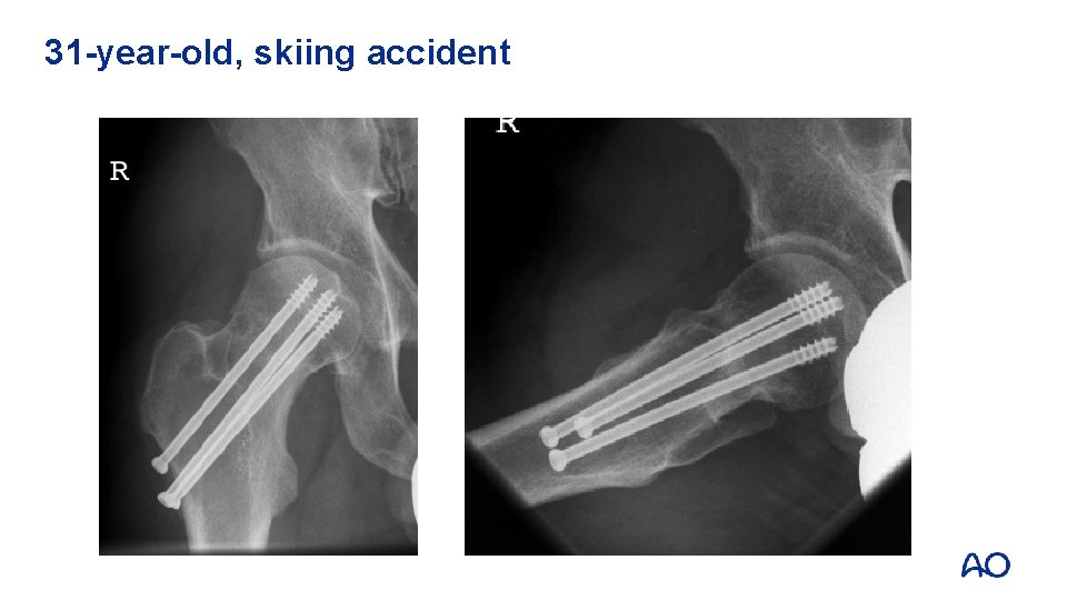 31 -year-old, skiing accident 