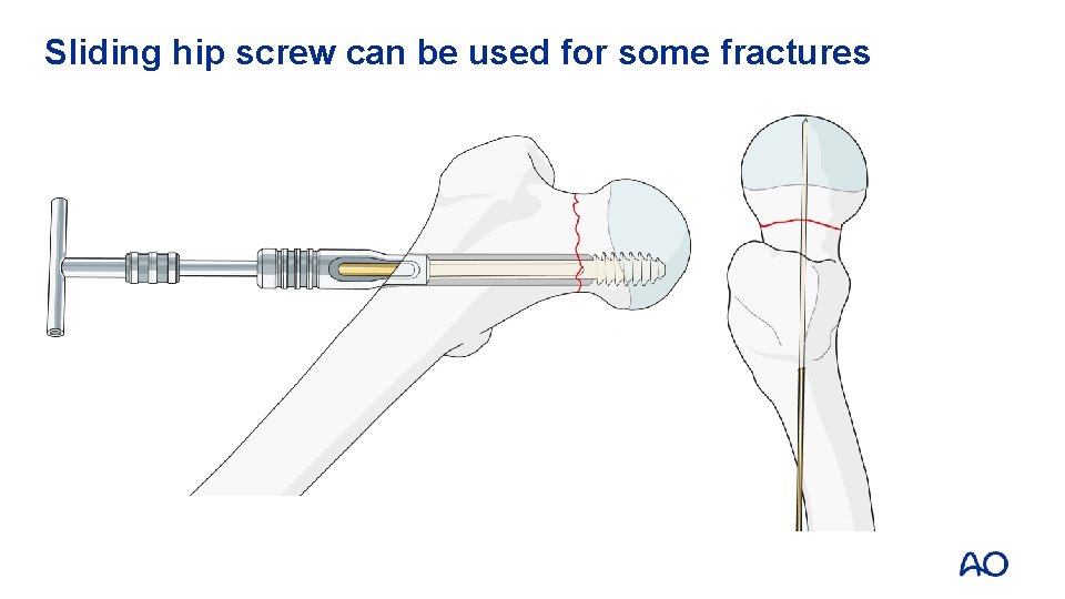 Sliding hip screw can be used for some fractures 