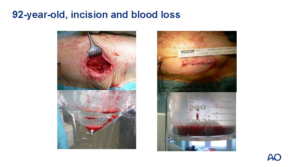 92 -year-old, incision and blood loss 