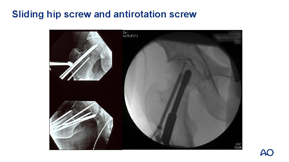 Sliding hip screw and antirotation screw 