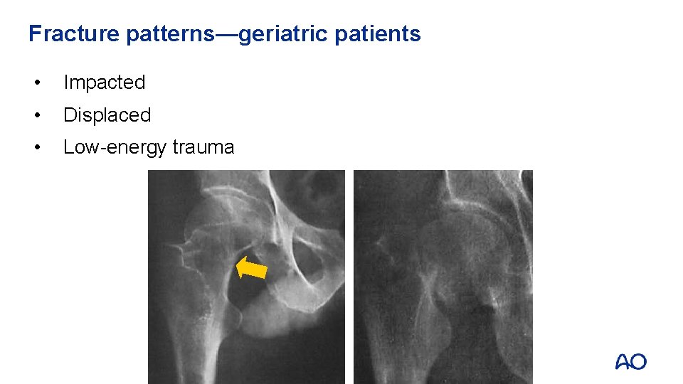 Fracture patterns—geriatric patients • Impacted • Displaced • Low-energy trauma 