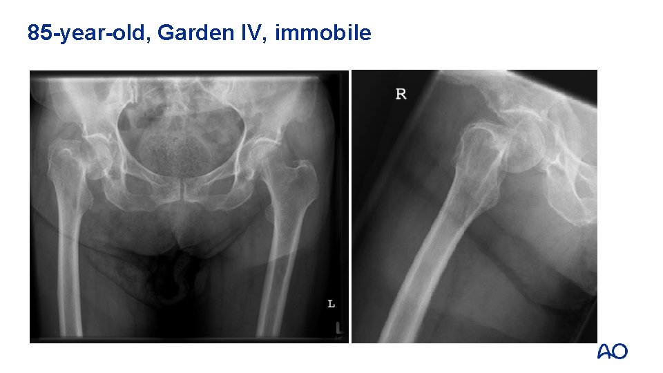 85 -year-old, Garden IV, immobile 