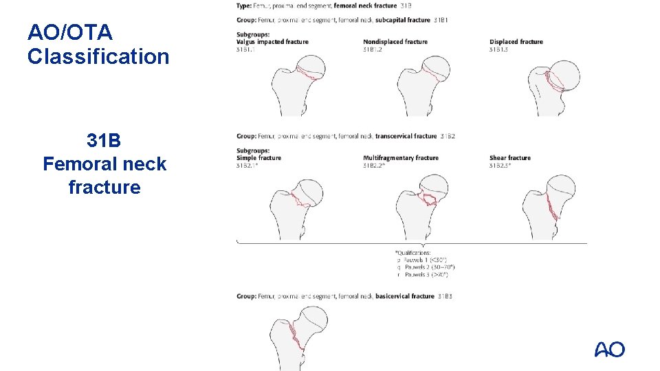 AO/OTA Classification 31 B Femoral neck fracture 