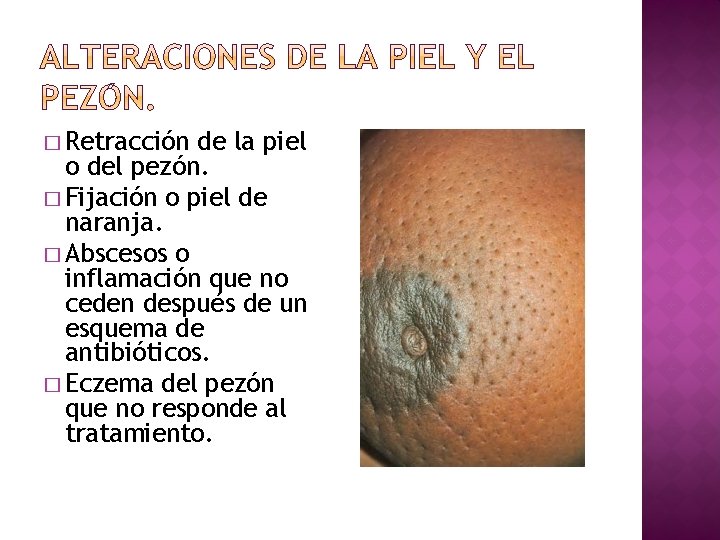 � Retracción de la piel o del pezón. � Fijación o piel de naranja.