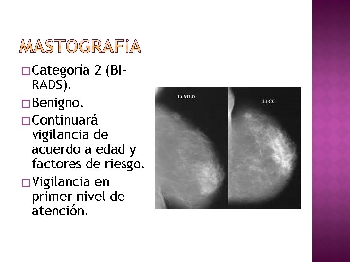 � Categoría 2 (BI- RADS). � Benigno. � Continuará vigilancia de acuerdo a edad