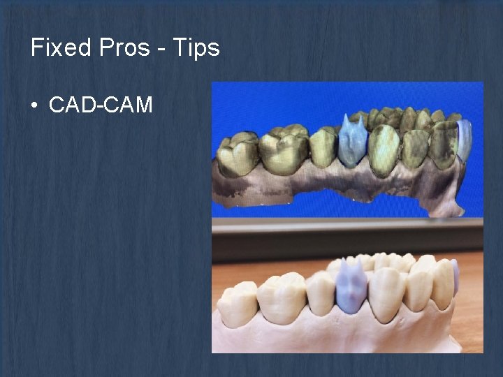 Fixed Pros - Tips • CAD-CAM 