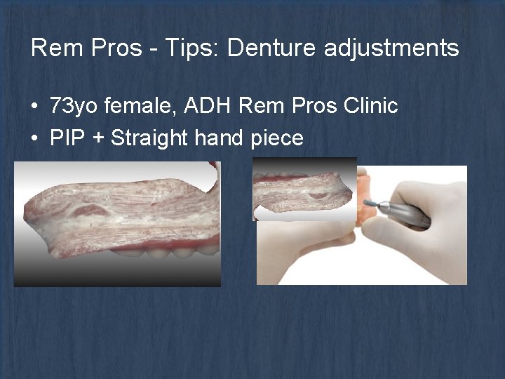 Rem Pros - Tips: Denture adjustments • 73 yo female, ADH Rem Pros Clinic