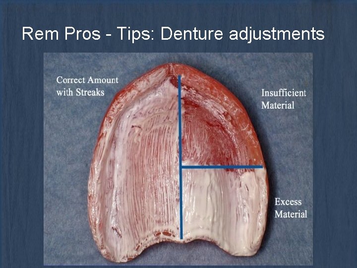 Rem Pros - Tips: Denture adjustments 