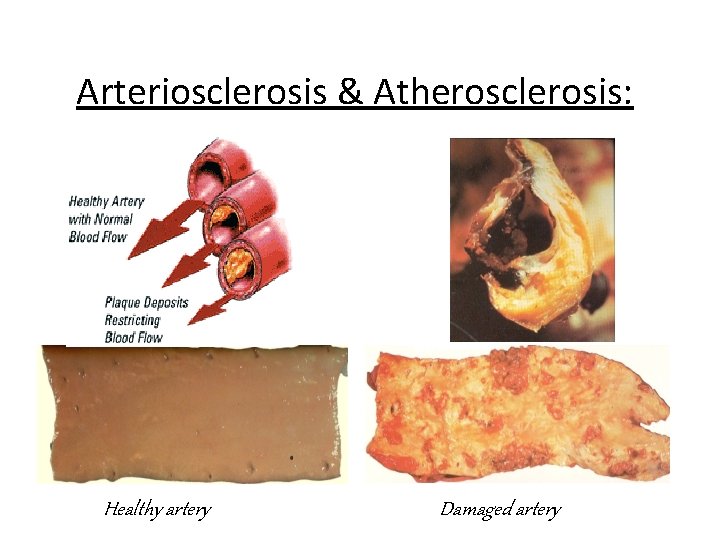 Arteriosclerosis & Atherosclerosis: Healthy artery Damaged artery 