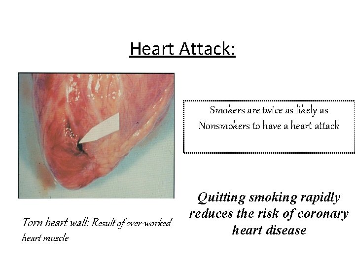 Heart Attack: Smokers are twice as likely as Nonsmokers to have a heart attack