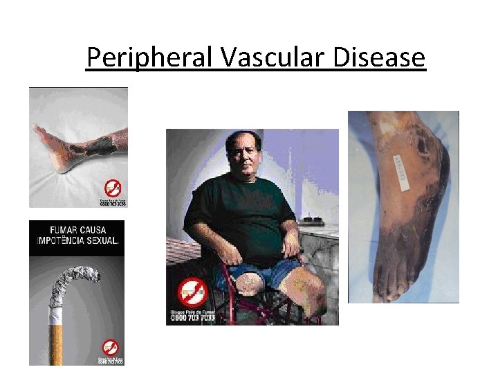 Peripheral Vascular Disease 