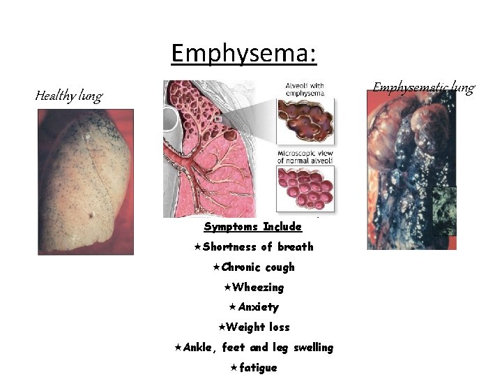 Emphysema: Emphysematic lung Healthy lung Symptoms Include «Shortness of breath «Chronic cough «Wheezing «Anxiety