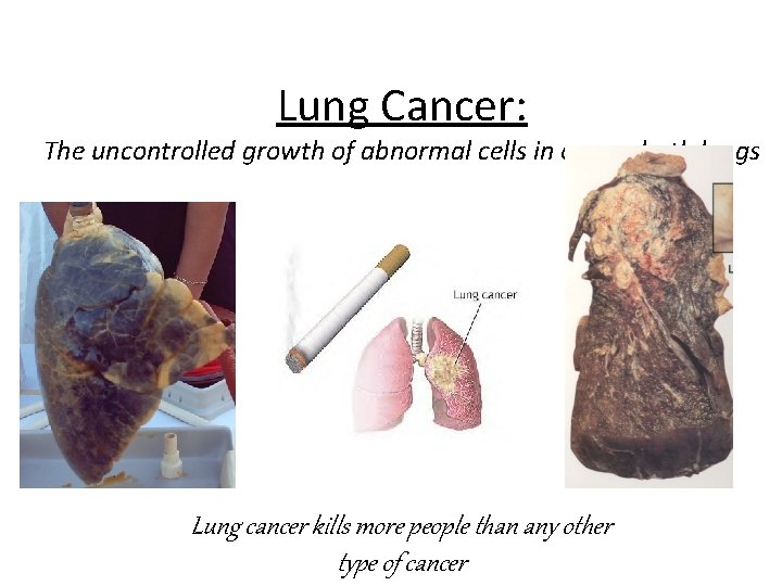 Lung Cancer: The uncontrolled growth of abnormal cells in one or both lungs Lung