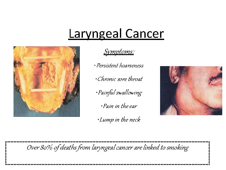 Laryngeal Cancer Symptoms: • Persistent hoarseness • Chronic sore throat • Painful swallowing •