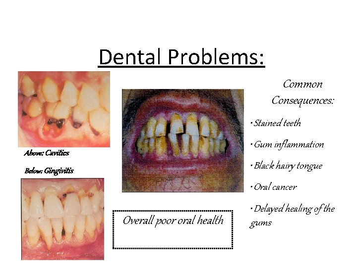 Dental Problems: Common Consequences: • Stained teeth • Gum inflammation Above: Cavities • Black