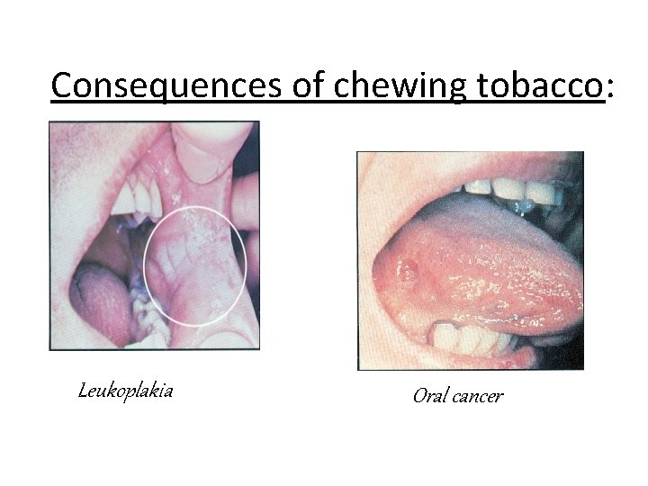 Consequences of chewing tobacco: Leukoplakia Oral cancer 