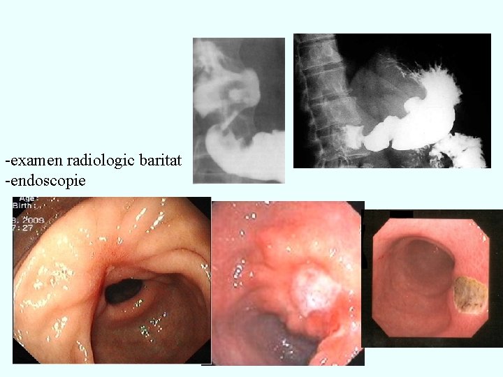 -examen radiologic baritat -endoscopie 