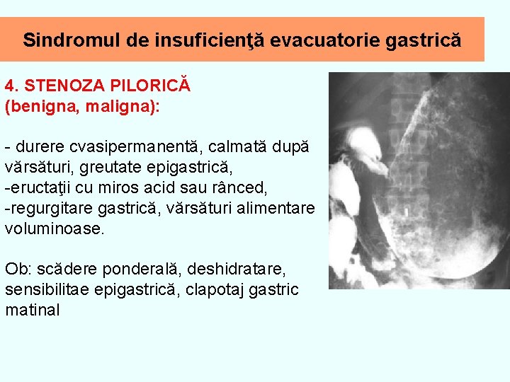 Sindromul de insuficienţă evacuatorie gastrică 4. STENOZA PILORICĂ (benigna, maligna): - durere cvasipermanentă, calmată