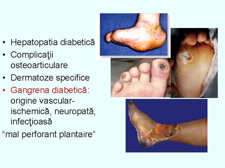  • Hepatopatia diabetică • Complicaţii osteoarticulare • Dermatoze specifice • Gangrena diabetică: origine