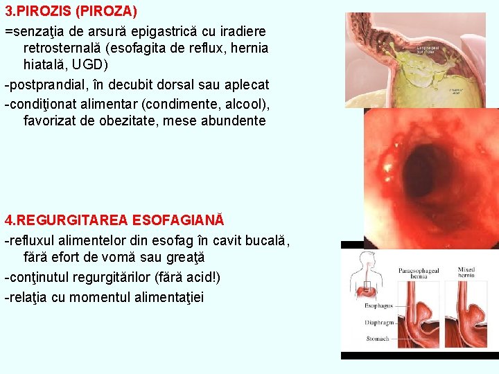 3. PIROZIS (PIROZA) =senzaţia de arsură epigastrică cu iradiere retrosternală (esofagita de reflux, hernia