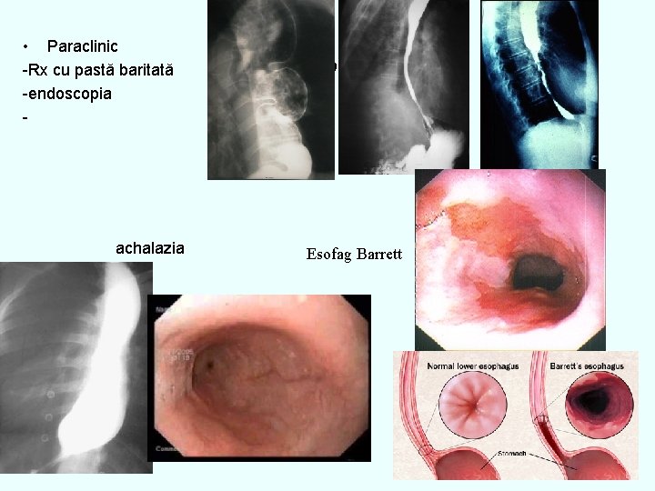  • Paraclinic -Rx cu pastă baritată -endoscopia - achalazia 333 Esofag Barrett 