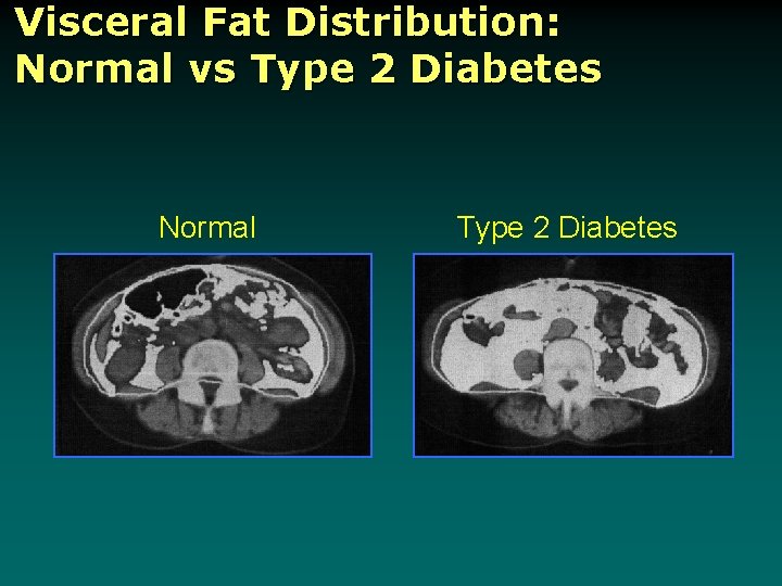 Visceral Fat Distribution: Normal vs Type 2 Diabetes Normal Type 2 Diabetes 