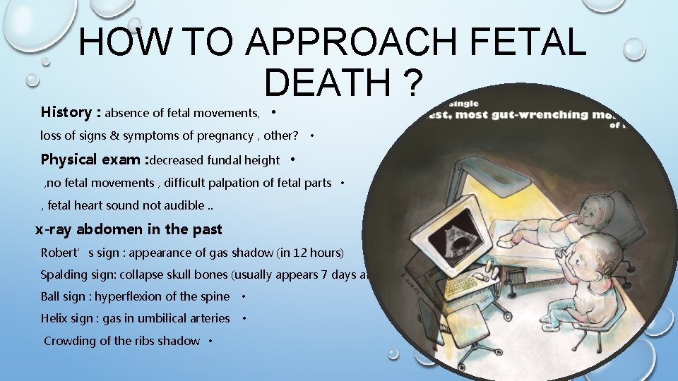 HOW TO APPROACH FETAL DEATH ? History : absence of fetal movements, • loss