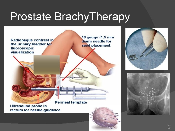 Prostate Brachy. Therapy 2 Prostate Brachy. Therapy 2