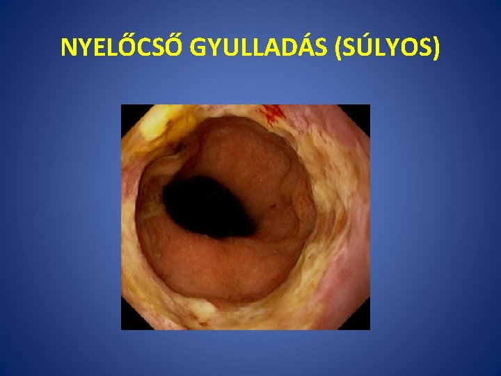 NYELŐCSŐ GYULLADÁS (SÚLYOS) 