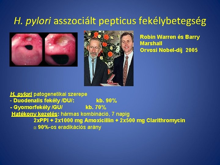 H. pylori asszociált pepticus fekélybetegség Robin Warren és Barry Marshall Orvosi Nobel-díj 2005 H.