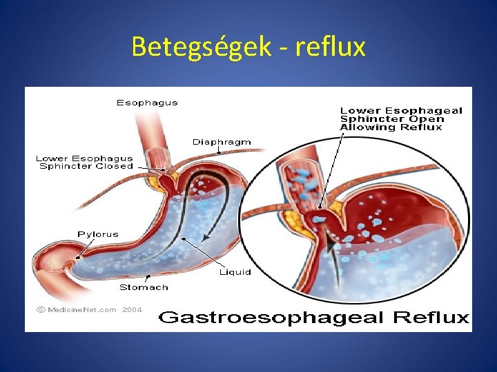 Betegségek - reflux 