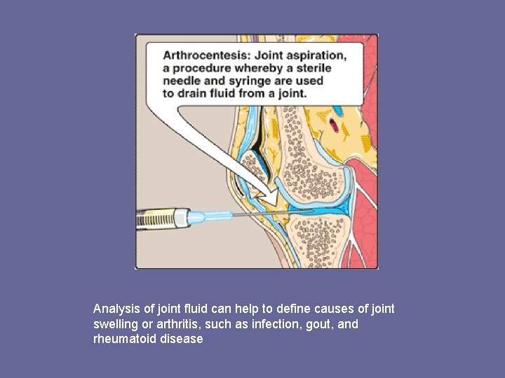 Analysis of joint fluid can help to define causes of joint swelling or arthritis,