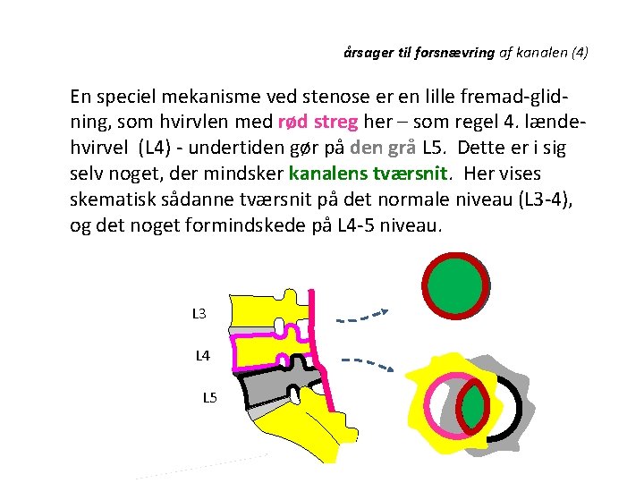 årsager til forsnævring af kanalen (4) En speciel mekanisme ved stenose er en lille