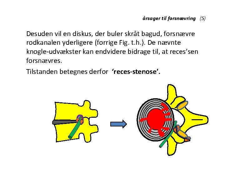 årsager til forsnævring (5) Desuden vil en diskus, der buler skråt bagud, forsnævre rodkanalen