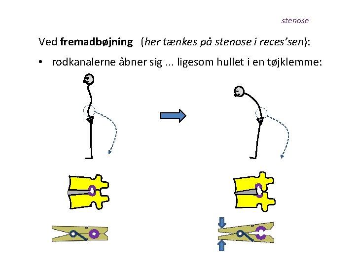 stenose Ved fremadbøjning (her tænkes på stenose i reces’sen): • rodkanalerne åbner sig. .