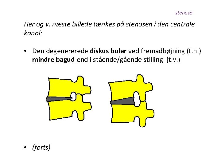 stenose Her og v. næste billede tænkes på stenosen i den centrale kanal: •