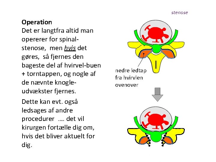 stenose Operation Det er langtfra altid man opererer for spinalstenose, men hvis det gøres,