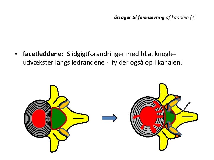 årsager til forsnævring af kanalen (2) • facetleddene: Slidgigtforandringer med bl. a. knogleudvækster langs