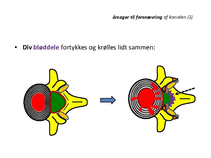 årsager til forsnævring af kanalen (3) • Div bløddele fortykkes og krølles lidt sammen: