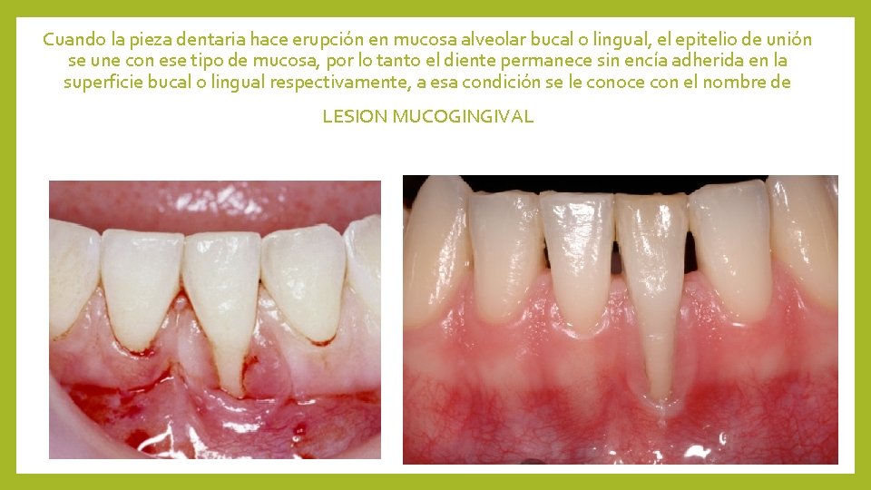 Cuando la pieza dentaria hace erupción en mucosa alveolar bucal o lingual, el epitelio