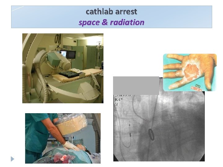 cathlab arrest space & radiation 