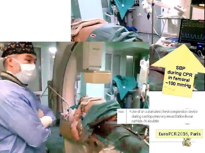 SBP during C PR in femo ra ~100 mm l Hg Euro. PCR 2016,