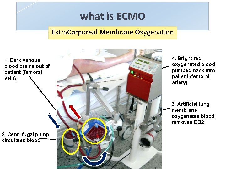 what is ECMO Extra. Corporeal Membrane Oxygenation 1. Dark venous blood drains out of