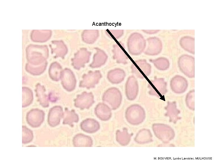 Acanthocyte M. BOUVIER, Lycée Lavoisier, MULHOUSE 