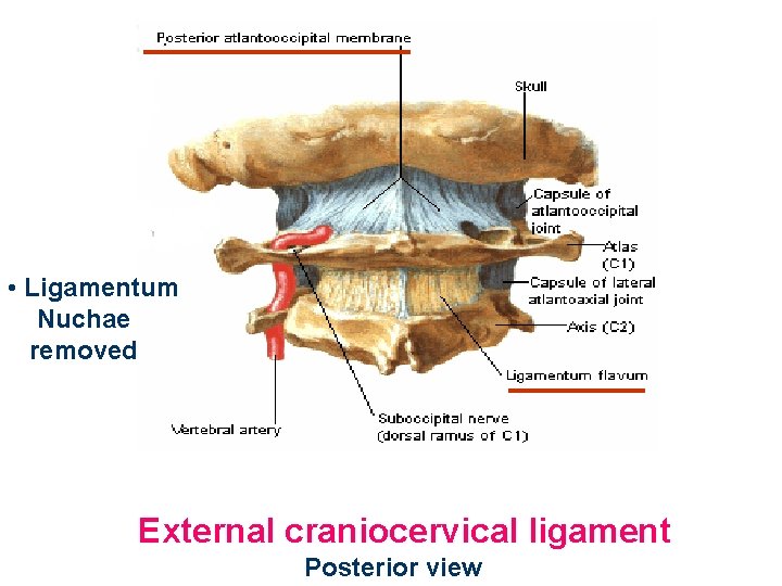  • Ligamentum Nuchae removed External craniocervical ligament Posterior view 