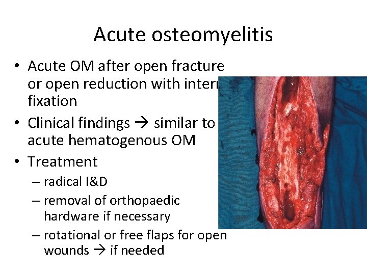 Acute osteomyelitis • Acute OM after open fracture or open reduction with internal fixation