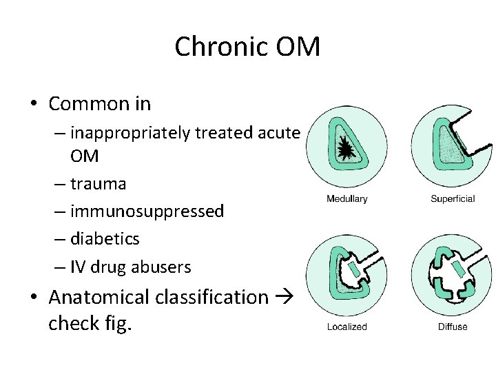 Chronic OM • Common in – inappropriately treated acute OM – trauma – immunosuppressed