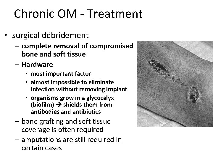 Chronic OM - Treatment • surgical débridement – complete removal of compromised bone and